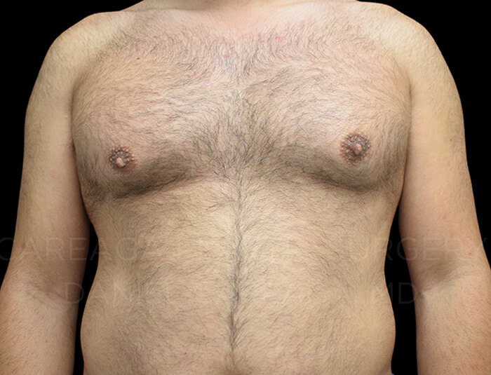 Gynecomastia before