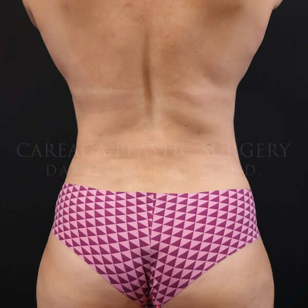 Liposuction 360 after
