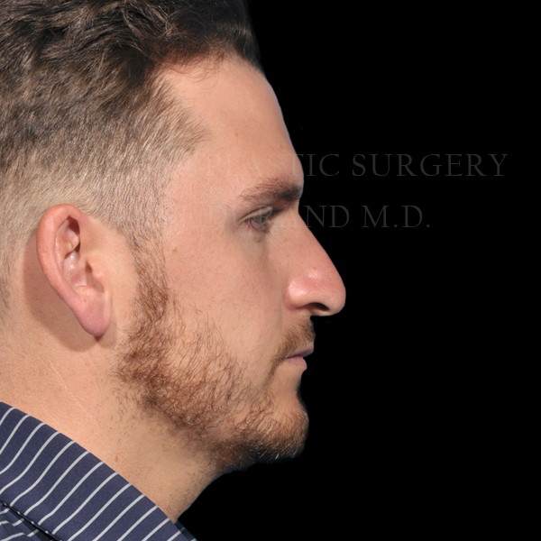 Rhinoplasty before